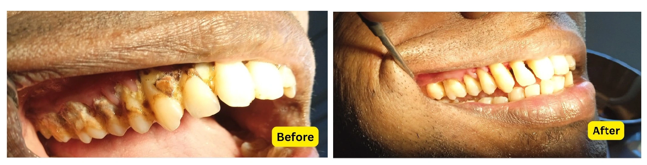 teeth cleaning